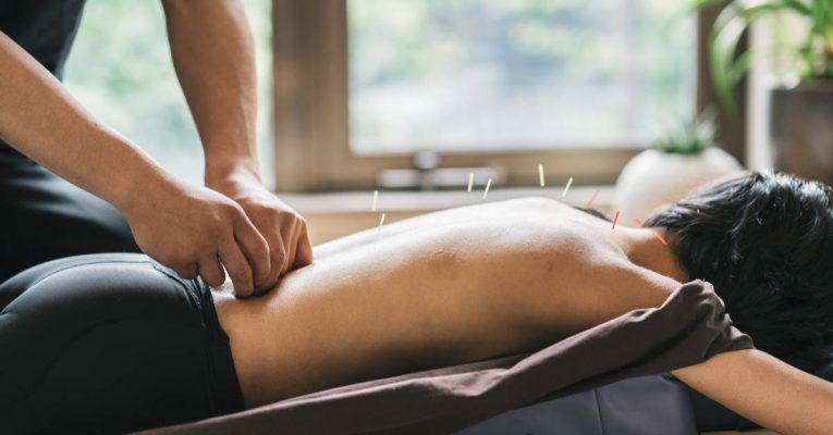 Séance d'acupuncture pratiquée sur le dos